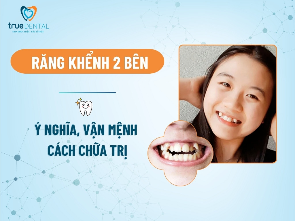 Răng khểnh 2 bên: Ý nghĩa, vận mệnh và cách chữa trị 2 Răng khểnh 2 bên: Ý nghĩa, vận mệnh và cách chữa trị