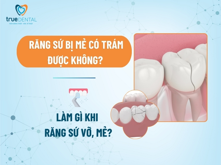 Răng sứ bị mẻ có trám được không? Làm gì khi răng sứ vỡ, mẻ?
