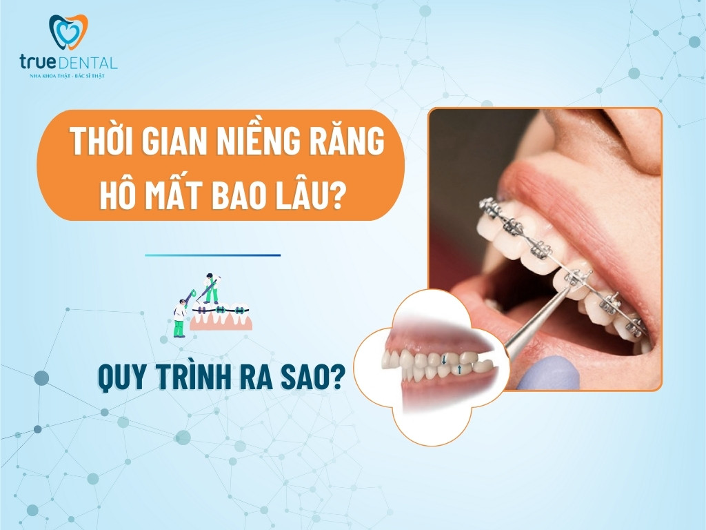 Thời gian niềng răng hô mất bao lâu? Quy trình ra sao? 8 Thời gian niềng răng hô mất bao lâu? Quy trình ra sao?