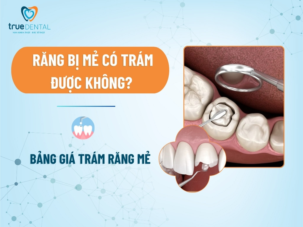 Răng bị mẻ có trám được không? Bảng giá trám răng mẻ 9 Răng bị mẻ có trám được không? Bảng giá trám răng mẻ