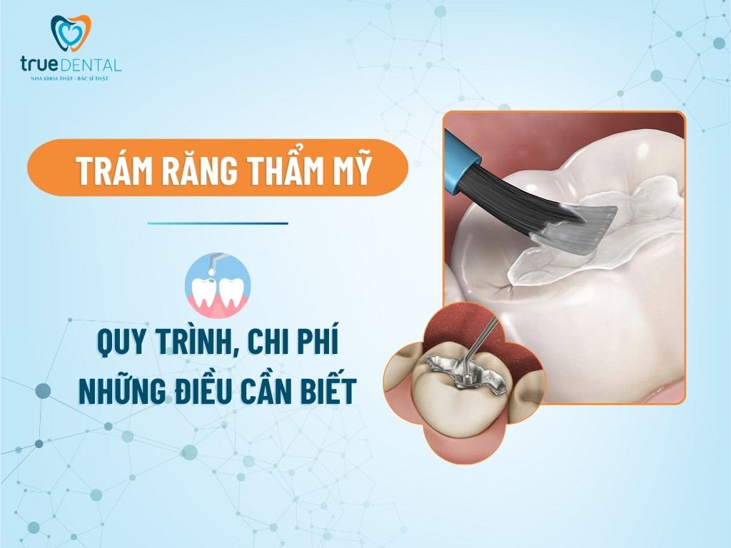 Trám răng thẩm mỹ: Quy trình, chi phí và những điều cần biết