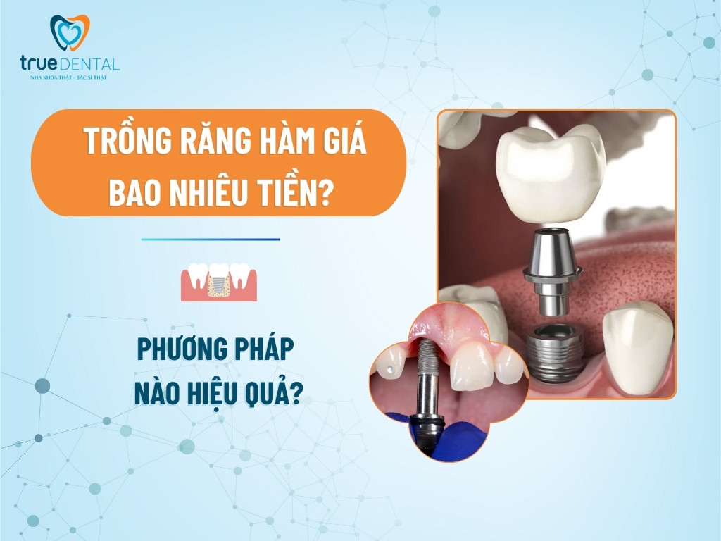 Trồng răng hàm giá bao nhiêu tiền? Phương pháp nào hiệu quả