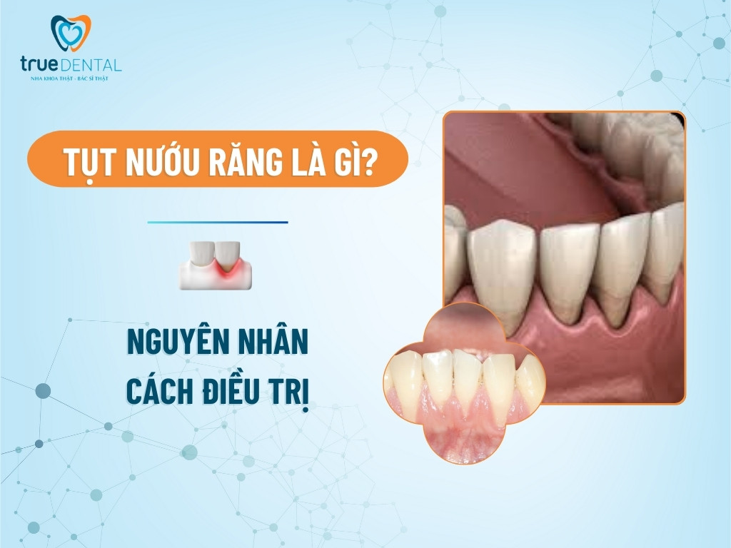 Tụt nướu răng là gì? Nguyên nhân và cách điều trị