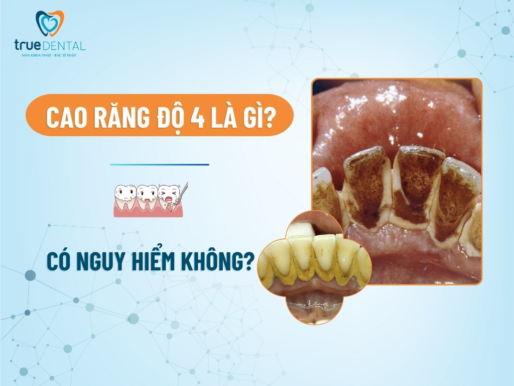 Cao răng độ 4 là gì? Có nguy hiểm không?