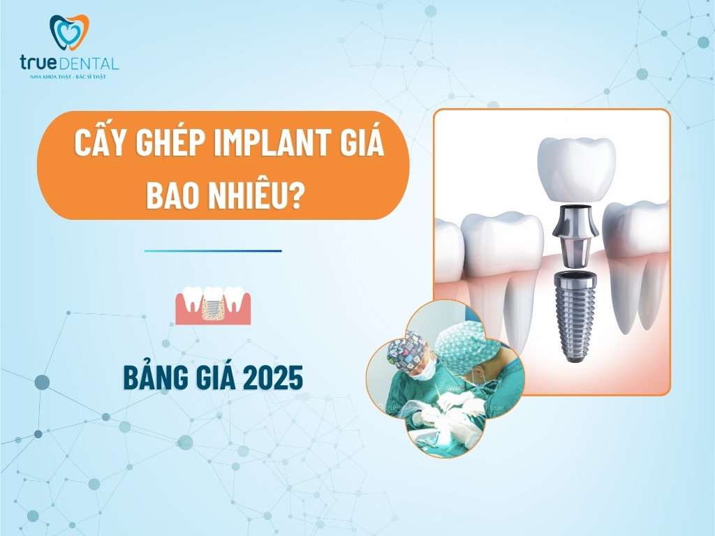 Cấy ghép implant giá bao nhiêu? Bảng giá 2025