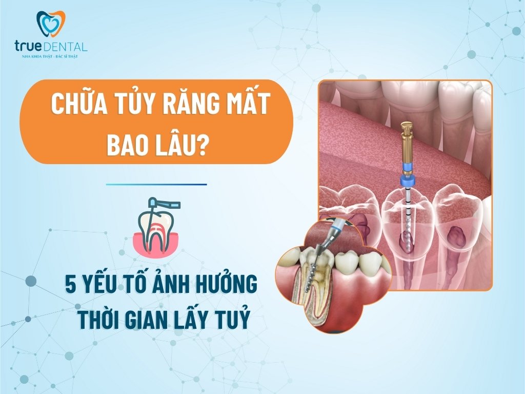 Chữa tủy răng mất bao lâu? 5 yếu tố ảnh hưởng thời gian lấy tuỷ 6 Chữa tủy răng mất bao lâu? 5 yếu tố ảnh hưởng thời gian lấy tuỷ