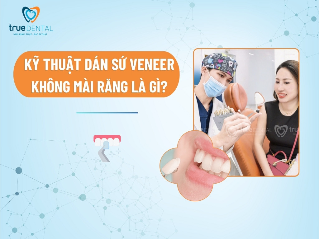 dan su veneer khong mai rang 1