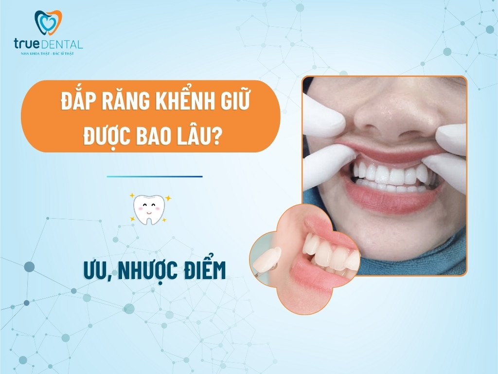 Đắp răng khểnh giữ được bao lâu? Ưu, nhược điểm
