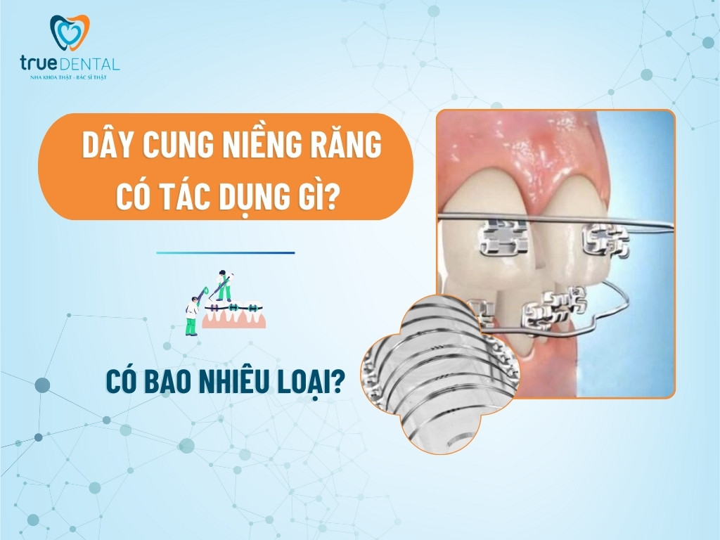 Dây cung niềng răng có tác dụng gì? Có bao nhiêu loại? 6 Dây cung niềng răng có tác dụng gì? Có bao nhiêu loại?