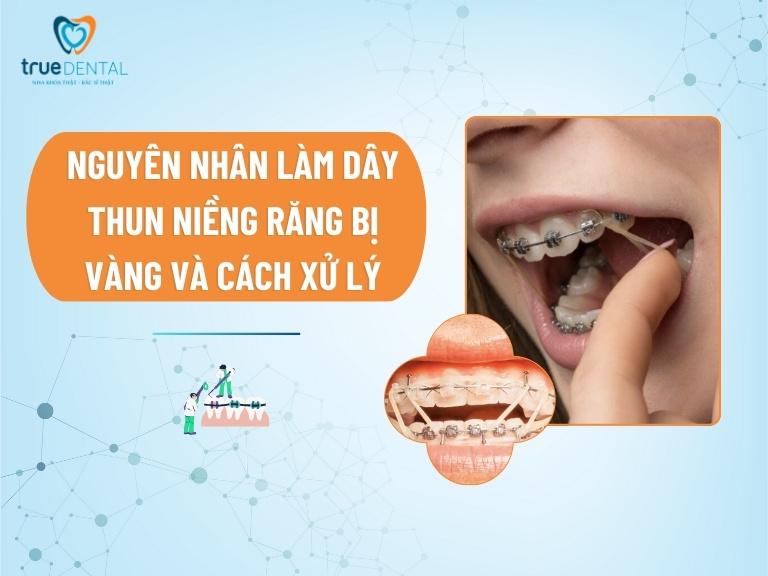 Nguyên nhân làm dây thun niềng răng bị vàng và cách xử lý 5 Nguyên nhân làm dây thun niềng răng bị vàng và cách xử lý