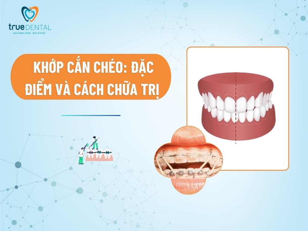 Khớp cắn chéo: Đặc điểm và cách chữa trị 1 Khớp cắn chéo: Đặc điểm và cách chữa trị