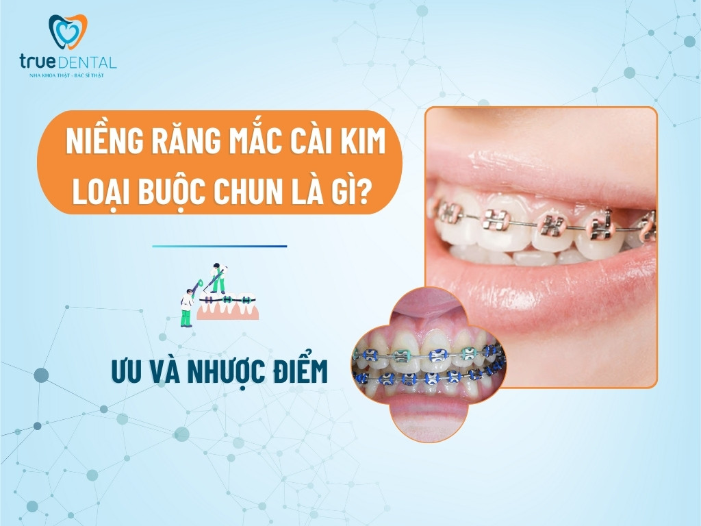 Niềng răng mắc cài kim loại buộc chun là gì? Ưu và nhược điểm 5 Niềng răng mắc cài kim loại buộc chun là gì? Ưu và nhược điểm
