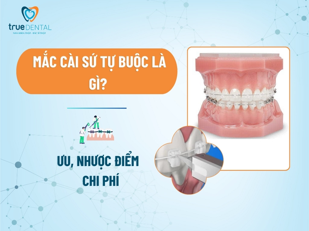 Mắc cài sứ tự buộc là gì? Ưu, nhược điểm và chi phí 4 mac cai su tu buoc la gi 1