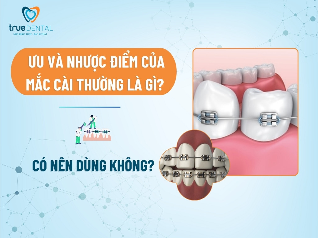 Ưu và nhược điểm của mắc cài thường là gì? Có nên dùng không? 3 Ưu và nhược điểm của mắc cài thường là gì? Có nên dùng không?