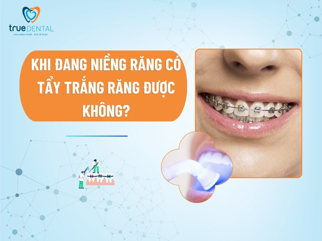 [Giải đáp] Khi đang niềng răng có tẩy trắng răng được không?