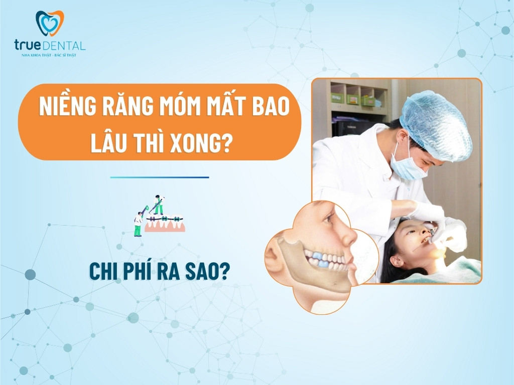Niềng răng móm mất bao lâu thì xong? Chi phí ra sao? 11 Niềng răng móm mất bao lâu thì xong? Chi phí ra sao?