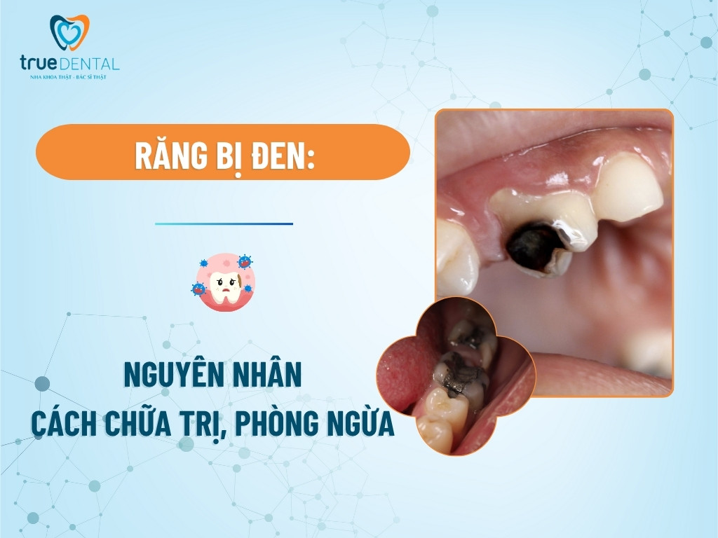 Răng bị đen: Nguyên nhân, cách chữa trị và phòng ngừa