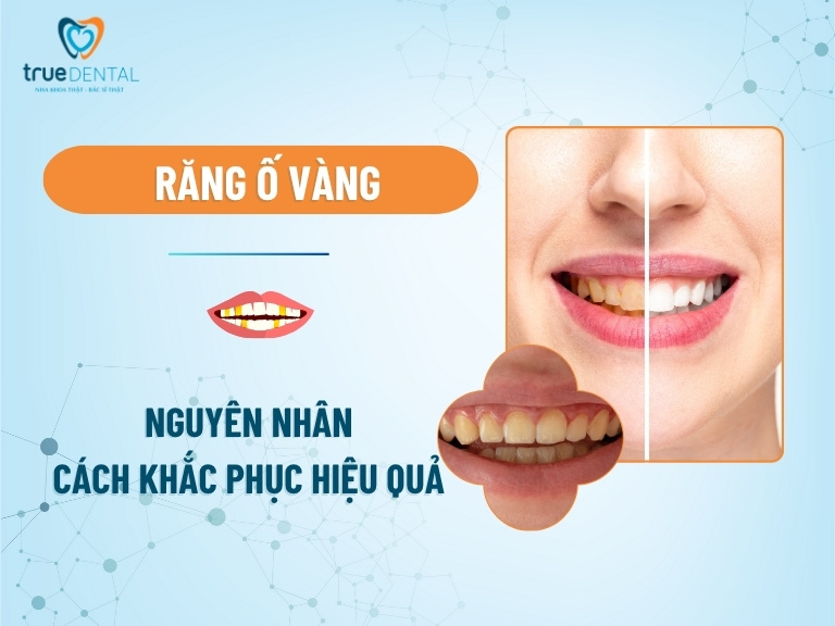 Răng ố vàng: Nguyên nhân và cách khắc phục hiệu quả
