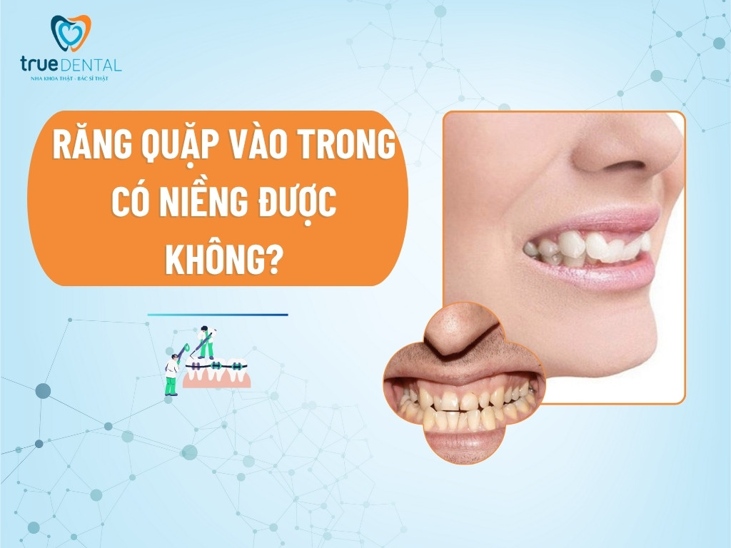 [Giải đáp] Răng quặp vào trong có niềng được không?