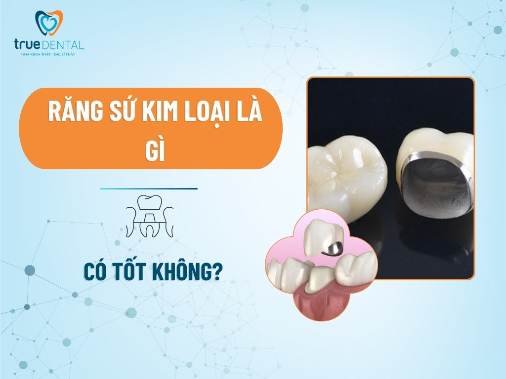 Răng sứ kim loại là gì? Có tốt không?