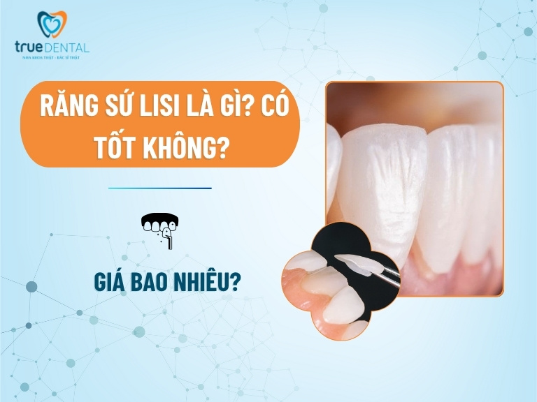 Răng sứ Lisi là gì? Có tốt không? Giá bao nhiêu?