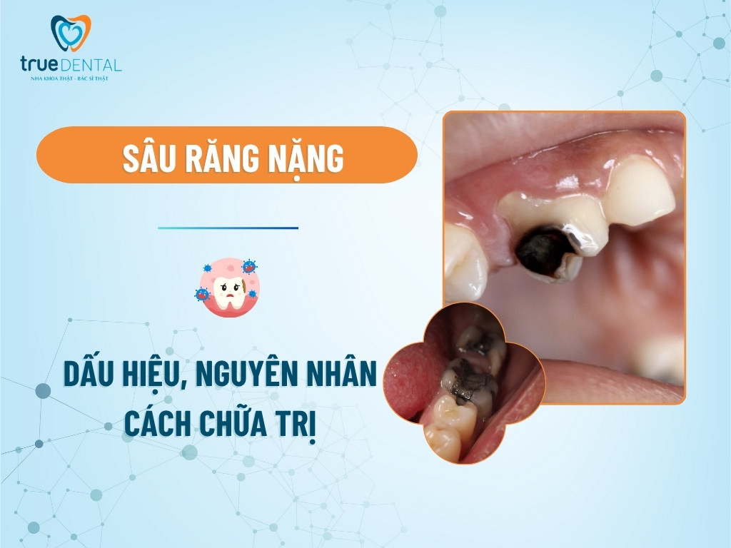 Sâu răng nặng: Dấu hiệu, nguyên nhân và cách chữa trị