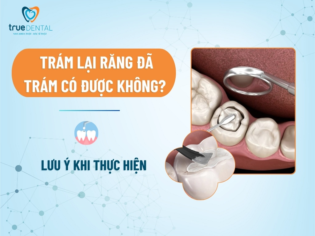 Trám lại răng đã trám có được không? Lưu ý khi thực hiện