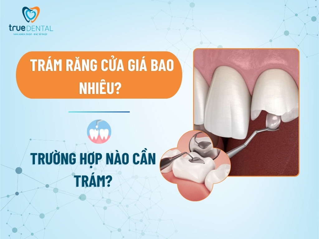 Trám răng cửa giá bao nhiêu? Trường hợp nào cần trám? 10 Trám răng cửa giá bao nhiêu? Trường hợp nào cần trám?