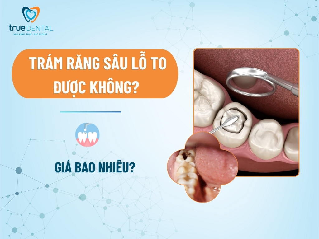 Trám răng sâu lỗ to được không? Giá bao nhiêu? 3 Trám răng sâu lỗ to được không? Giá bao nhiêu?
