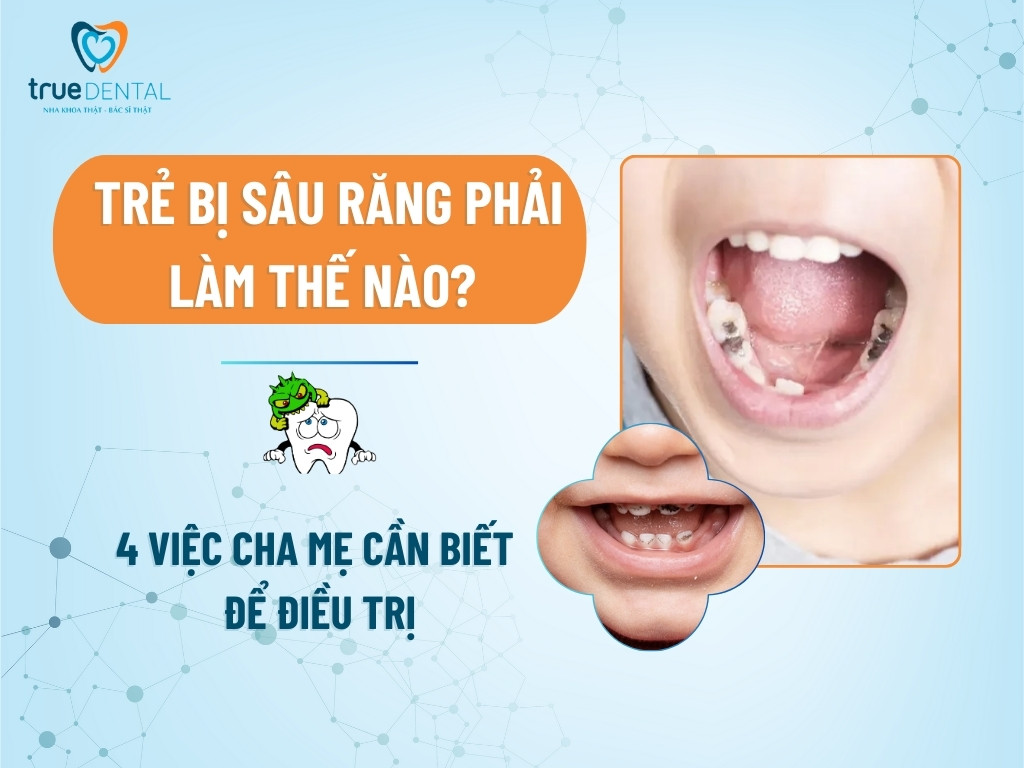 Trẻ bị sâu răng phải làm thế nào? 4 việc cha mẹ cần biết để điều trị