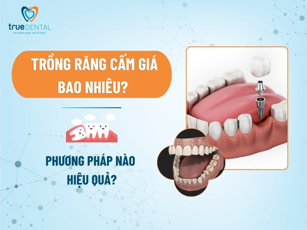 Trồng răng cấm giá bao nhiêu? Phương pháp nào hiệu quả