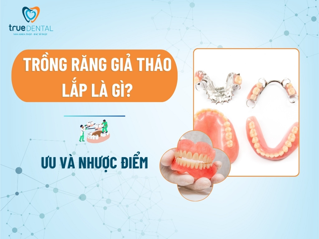 Trồng răng giả tháo lắp là gì? Ưu và nhược điểm 8 Trồng răng giả tháo lắp là gì? Ưu và nhược điểm
