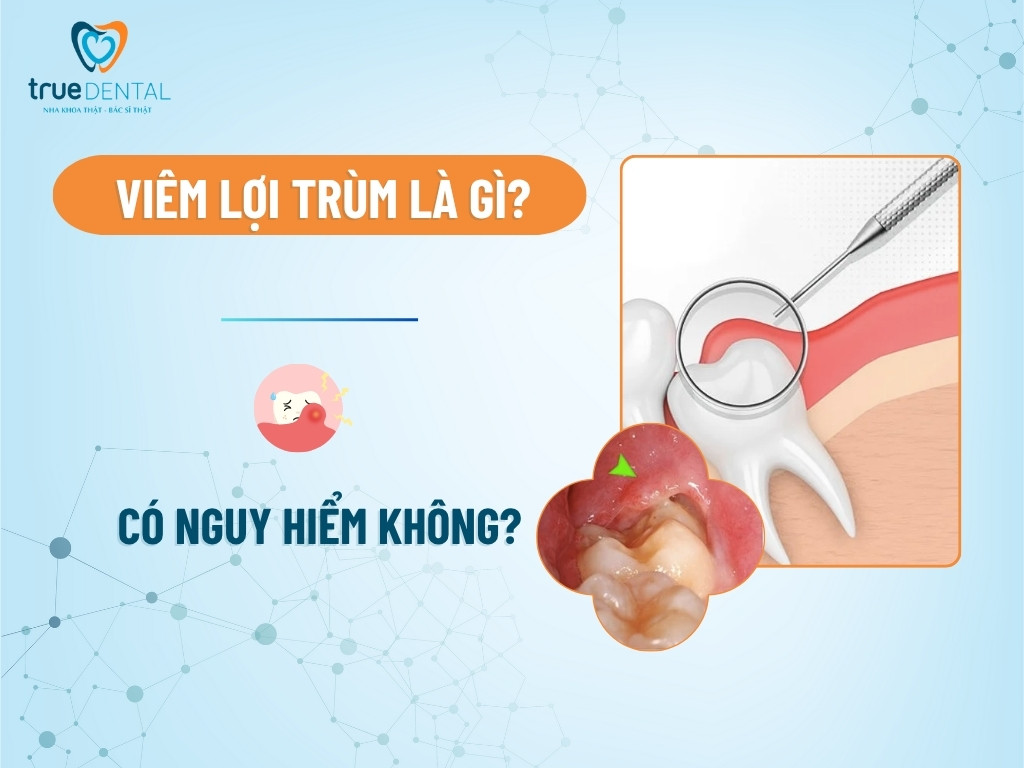 Viêm lợi trùm là gì? Có nguy hiểm không?