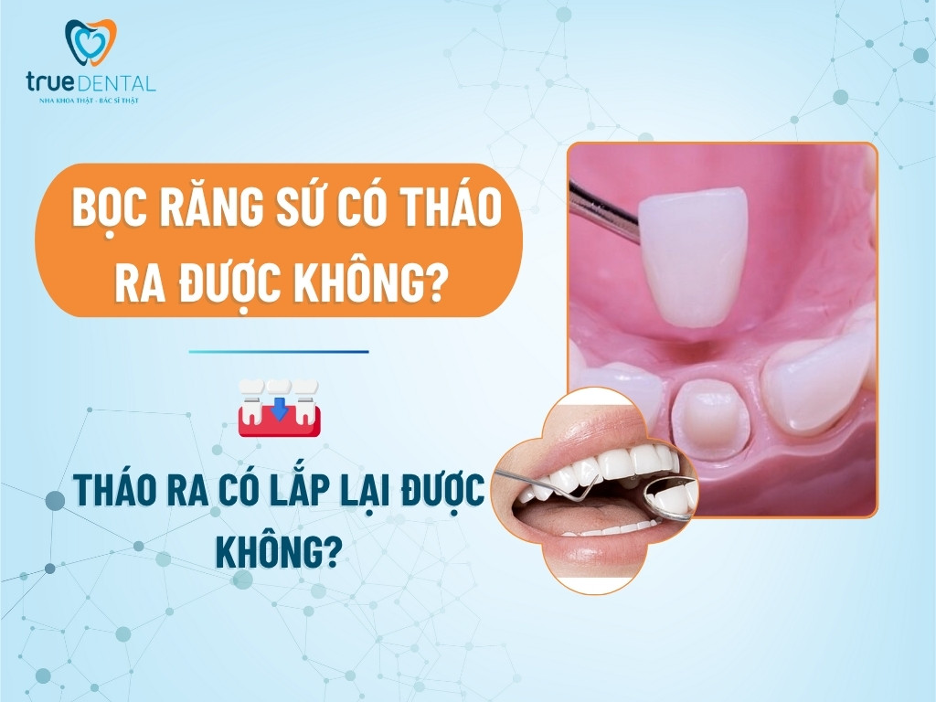 Bọc răng sứ có tháo ra được không? Tháo ra có lắp lại được không? 6 Bọc răng sứ có tháo ra được không? Tháo ra có lắp lại được không?