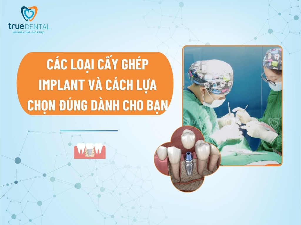 Các Loại Cấy Ghép Implant Và Cách Lựa Chọn Đúng Dành Cho Bạn