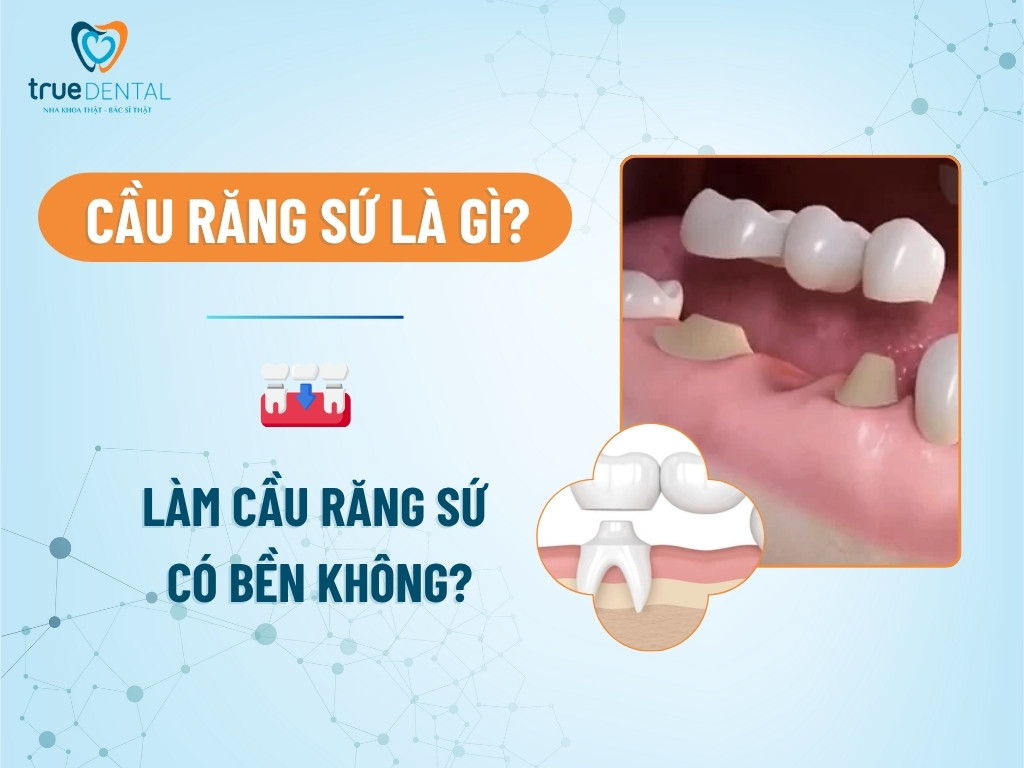 Cầu răng sứ là gì? Làm cầu răng sứ có bền không? 8 Cầu răng sứ là gì? Làm cầu răng sứ có bền không?