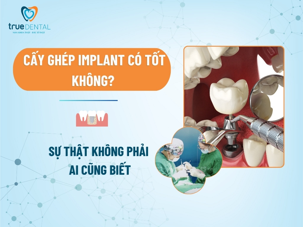 Cấy Ghép Implant Có Tốt Không? Sự Thật Không Phải Ai Cũng Biết