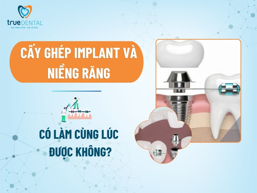 Cấy Ghép Implant Và Niềng Răng: Có Làm Cùng Lúc Được Không?