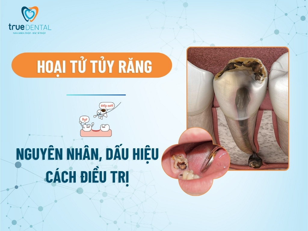 Hoại tử tủy răng: Nguyên nhân, dấu hiệu và cách điều trị