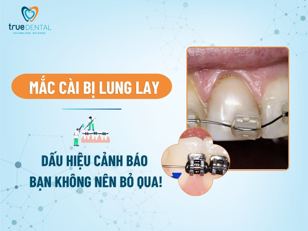 Mắc Cài Bị Lung Lay: Dấu Hiệu Cảnh Báo Bạn Không Nên Bỏ Qua!