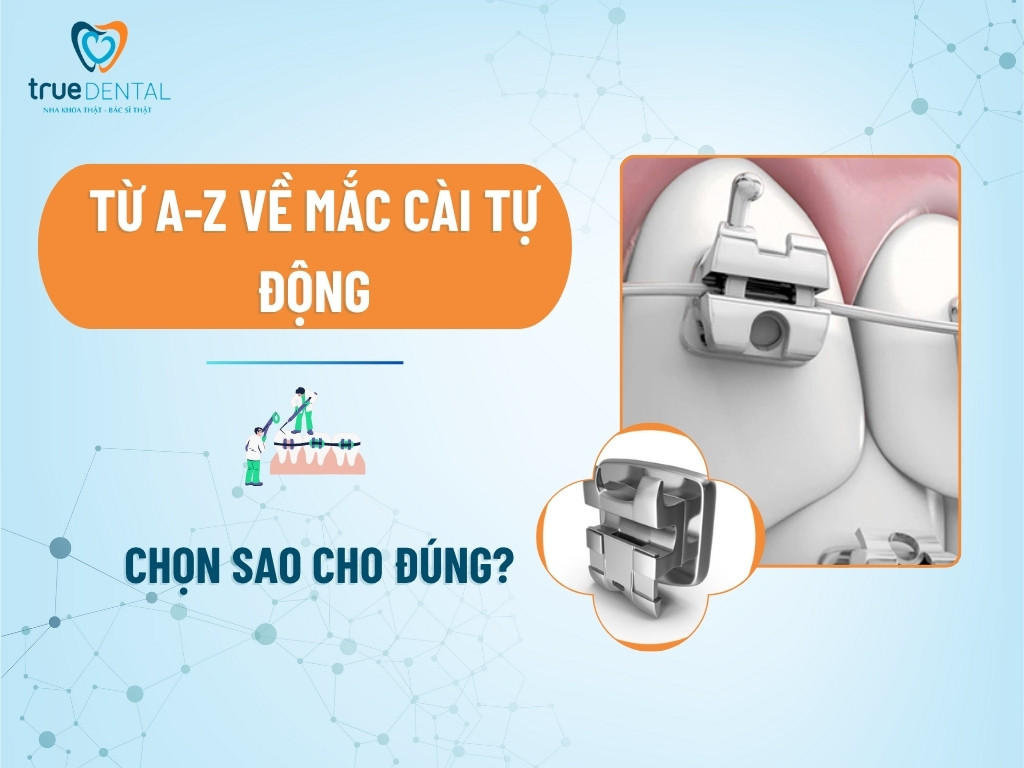 Từ A-Z Về Mắc Cài Tự Động: Chọn Sao Cho Đúng?