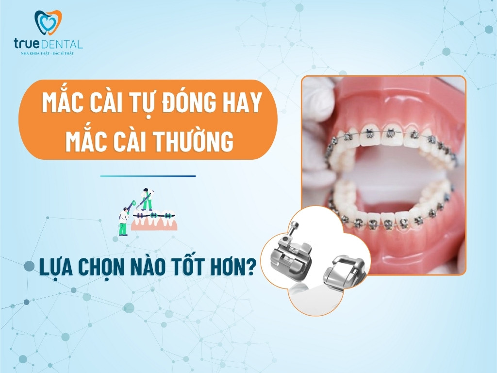 Mắc Cài Tự Đóng hay Mắc Cài Thường – Lựa Chọn Nào Tốt Hơn?