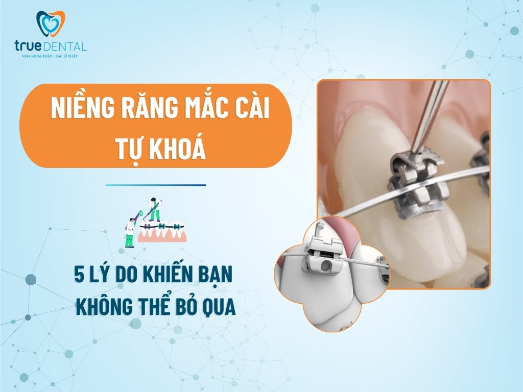 Niềng Răng Mắc Cài Tự Khoá: 5 Lý Do Khiến Bạn Không Thể Bỏ Qua