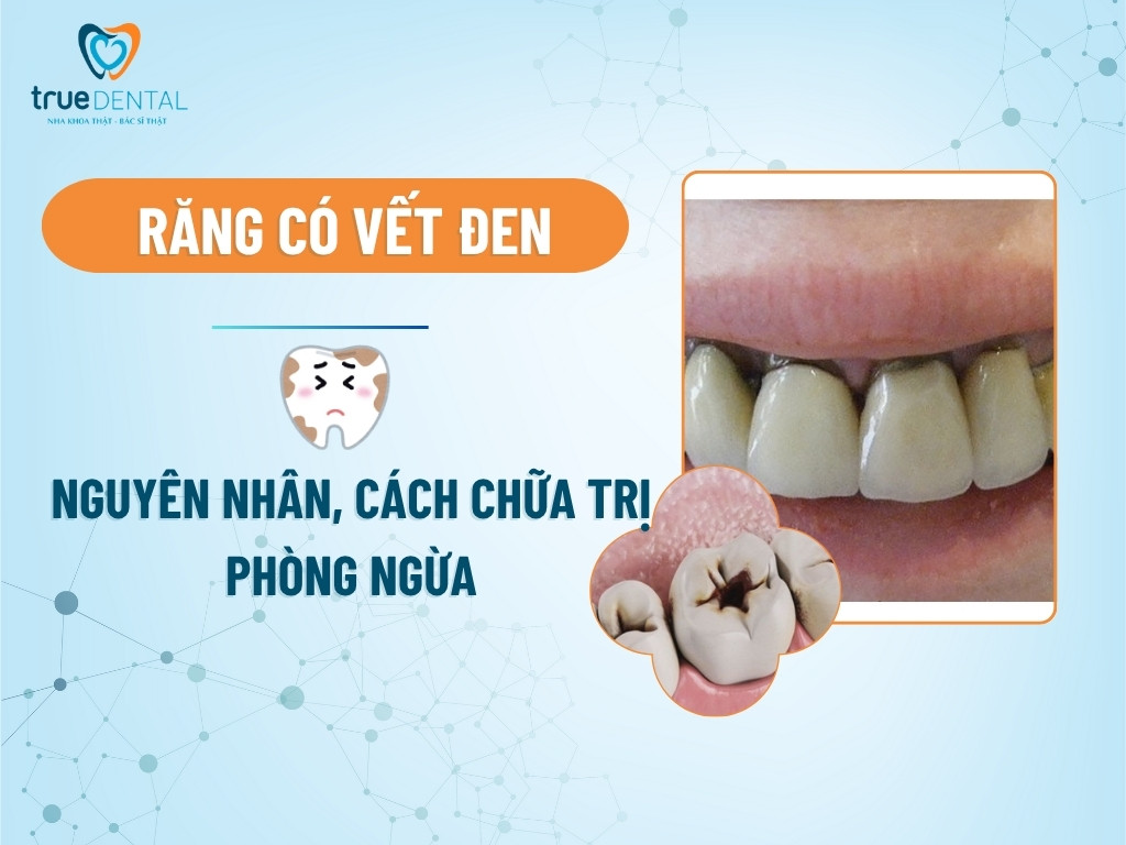 Răng có vết đen: Nguyên nhân, cách chữa trị và phòng ngừa