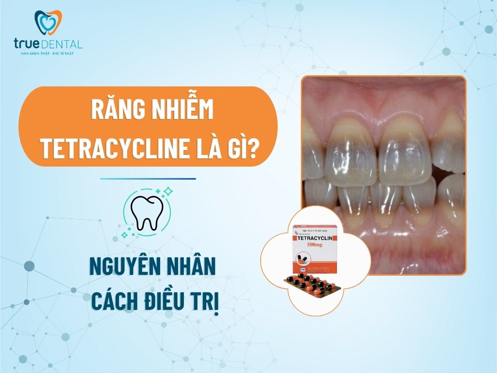 Răng nhiễm Tetracycline là gì? Nguyên nhân và cách điều trị