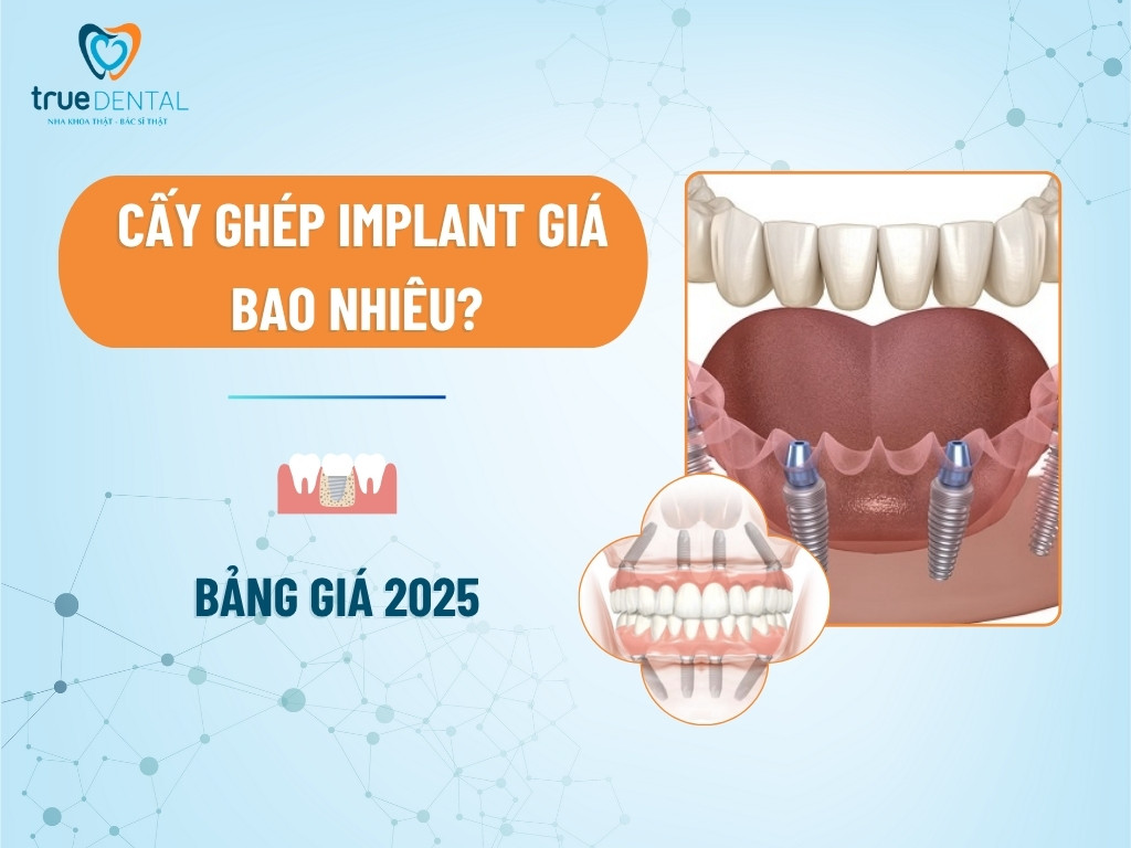 Trồng răng Implant All on 4 là gì? giá bao nhiêu?
