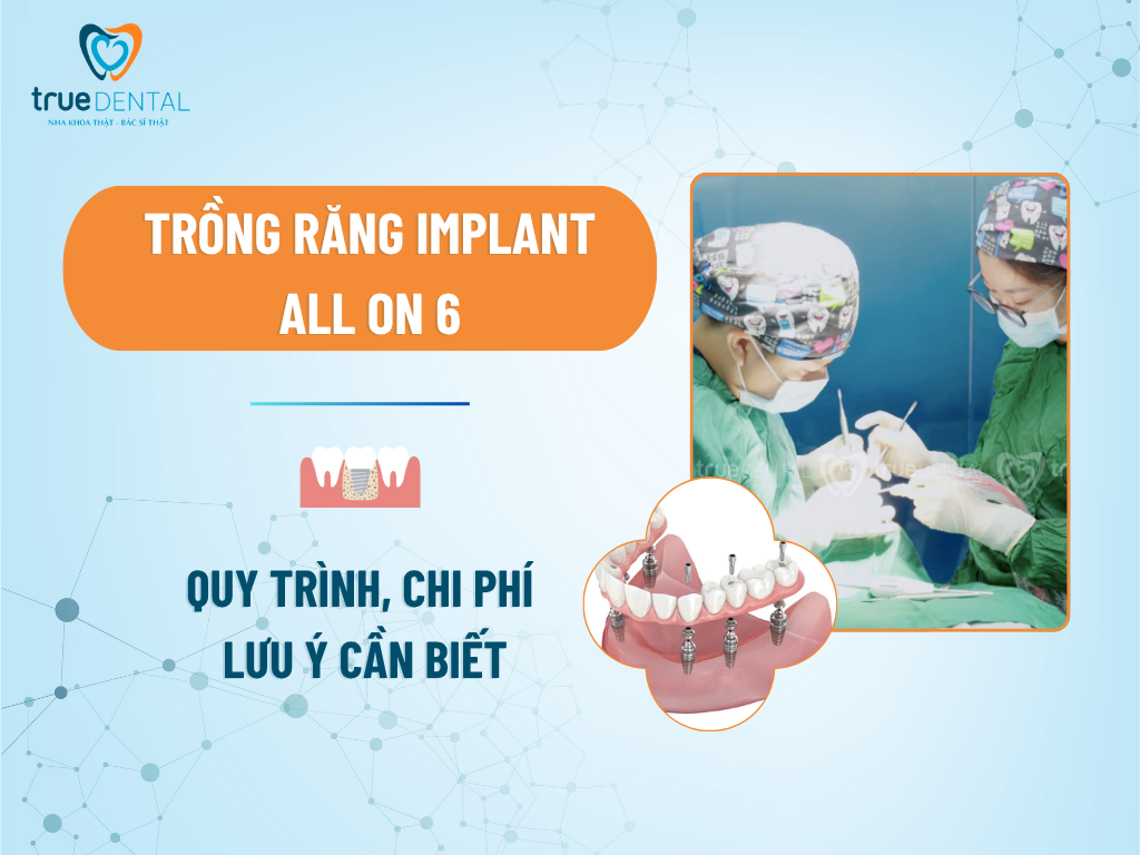 Trồng răng Implant All on 6: Quy trình, chi phí và lưu ý cần biết