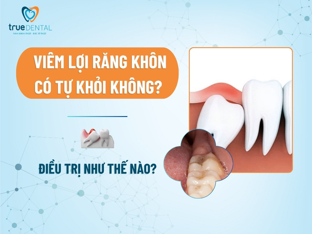 Viêm lợi răng khôn có tự khỏi không? Điều trị như thế nào?