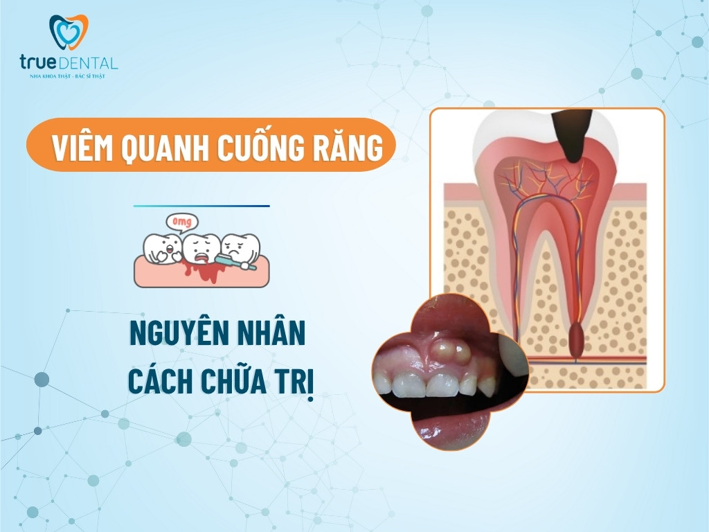 Viêm quanh cuống răng: Nguyên nhân và cách chữa trị