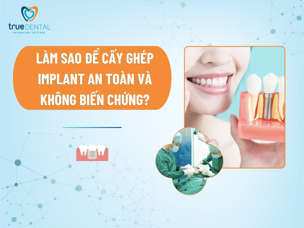 Làm Sao Để Cấy Ghép Implant An Toàn Và Không Biến Chứng?